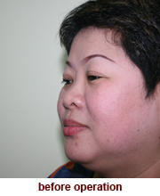 plastic_surgery_augmentation_rhinoplasty